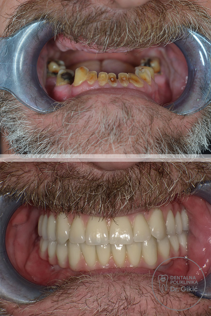 zygoma-prije-poslije